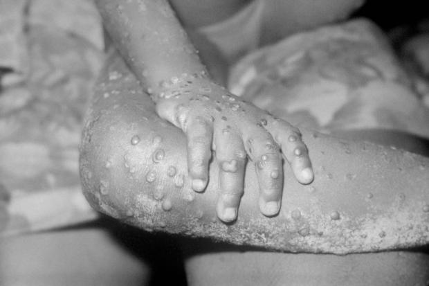 Oxford Mail: The monkeypox virus can be spread in a number of ways. Picture: PA