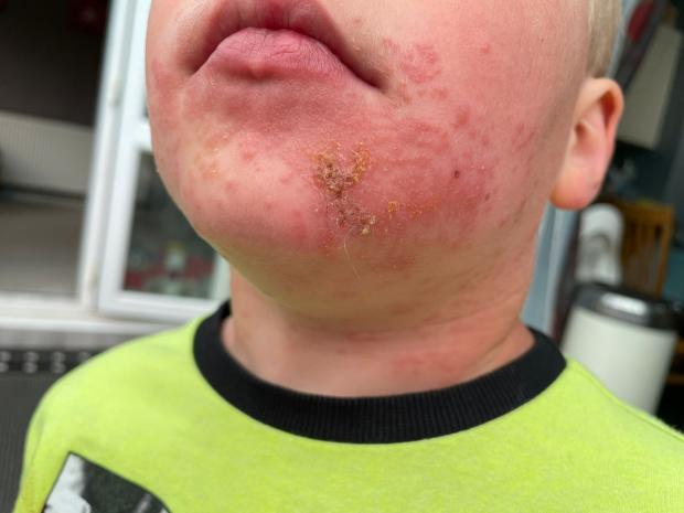 Oxford Mail: Within 30 minutes a rash had formed on Oliver's face. Picture: Caroline Gel