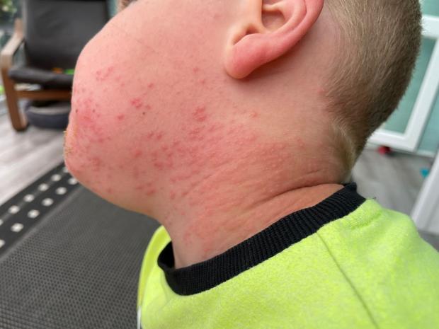 Oxford Mail: Oliver came out in a rash and hives after touching the insect. Picture: Caroline Gel