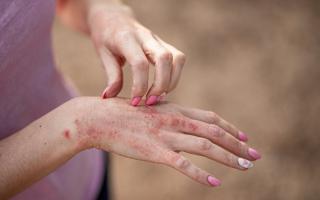 What is contact dermatitis? The NHS explains symptoms and when to see a doctor or pharmacist