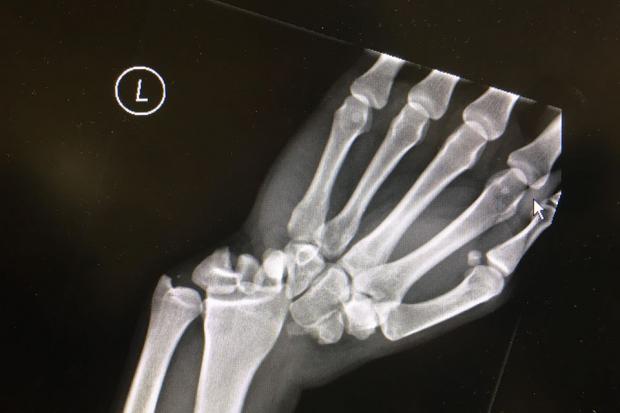 An X-Ray of Jason Ikin's hand